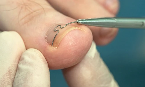 bild-spangentherapie Spangentherapie